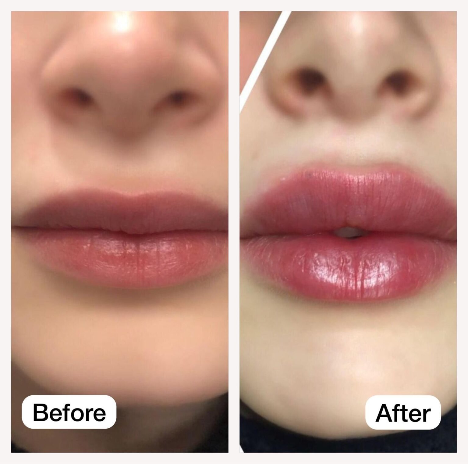 Dr. Haifa Al-Fakouri — Lip filler